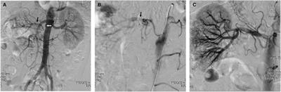 Case Report: Endovascular Treatment of Chronic Atherosclerotic Renal Artery Total Occlusions with Failed Medical Therapy